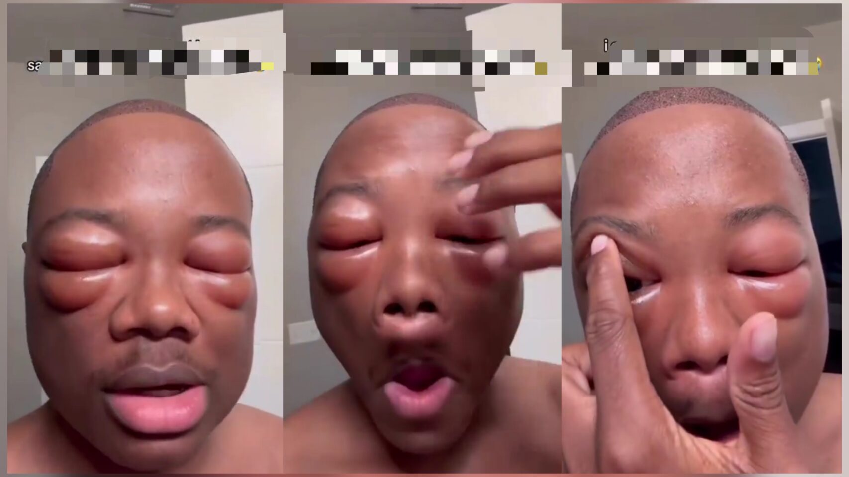Man Claims 1% Vision After Hair Transplant Procedure Sparks Online Buzz